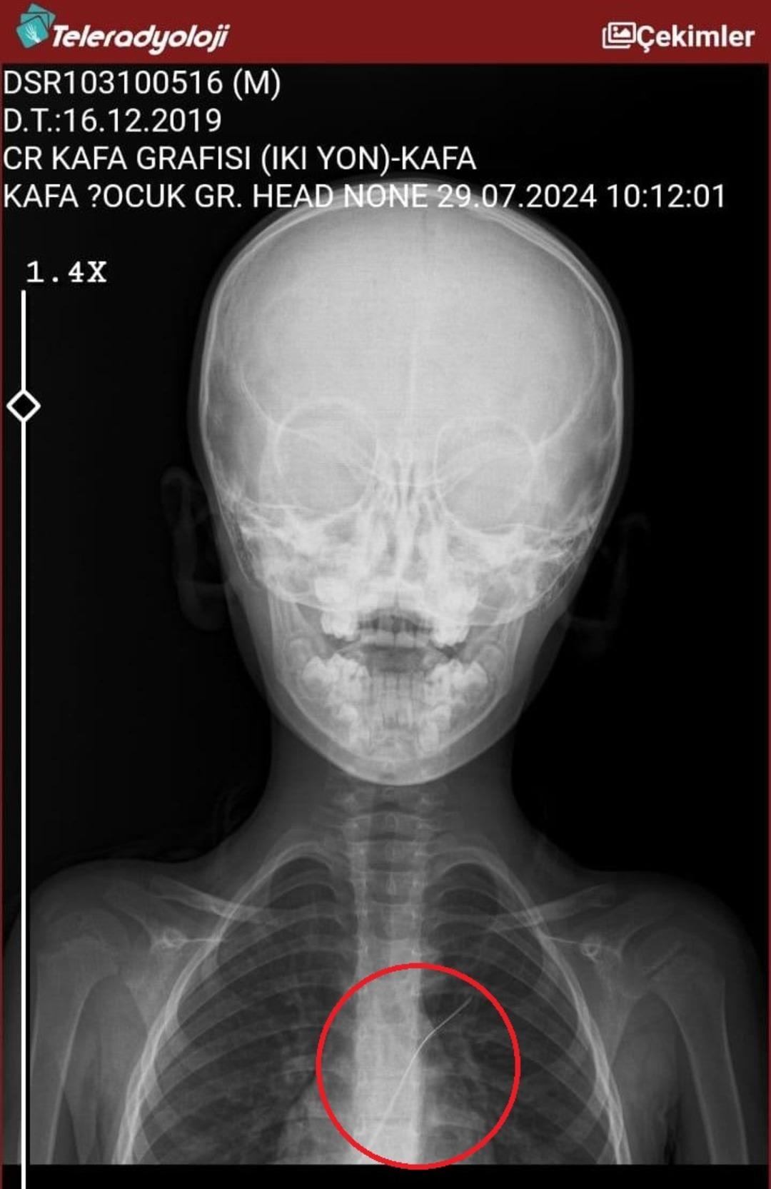 3 yıl sonra ortaya çıktı: 18 santimetre Catharers unuttu! Salatalık yutulduğunda ortaya çıktı 3
